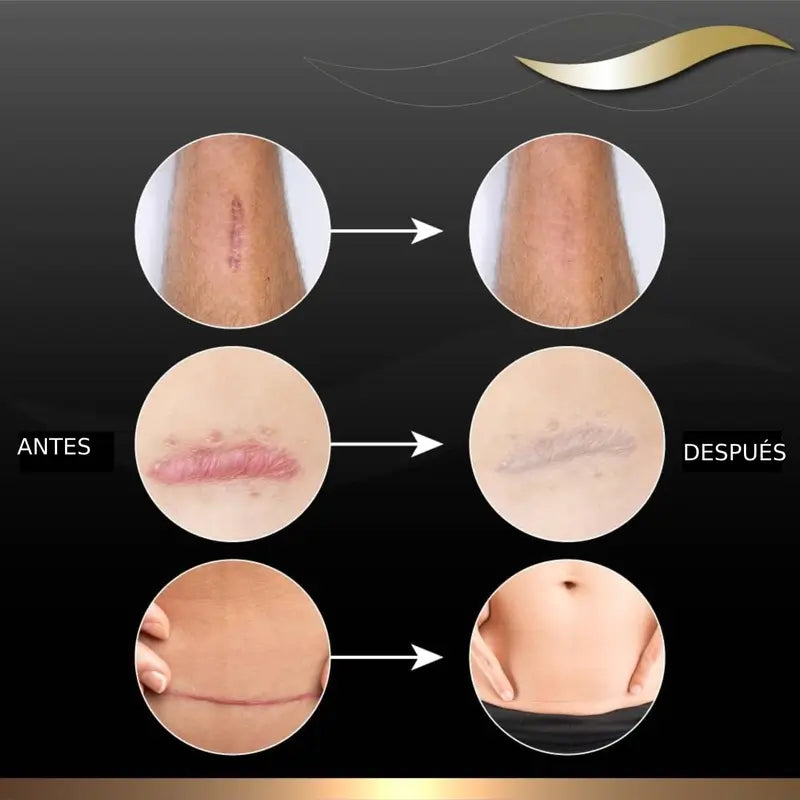 Dermatix Silicone Gel Scar Treatment, 15g