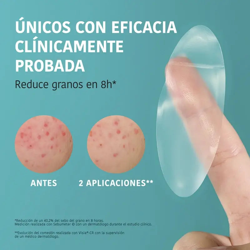 Iroha Nature Xl Pimple Patch , 5 units